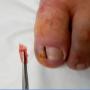 Ingrown Toenail Clinics Australia
