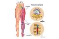 Sciatica Treatment Adelaide