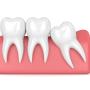wisdom tooth removal - wisdom teeth professionals - sydney