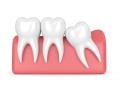 Dr Paulo Pinho Removes Over 30,000 Wisdom Teeth at Wisdom Teeth Professionals