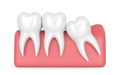 wisdom-teeth-removal
