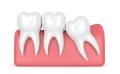 Signs You Need Wisdom Teeth Removal