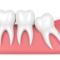 wisdom-teeth-removal