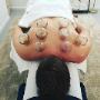 Chinese medicine cupping sunshine coast