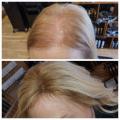 Hair loss replacement