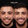Alexis before and after