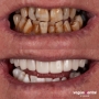 Before and after smile makeover with veneers