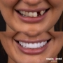 Laura before and after