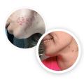 Hormonal Acne Treatment Online