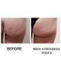Fat Freezing.
4 weeks progress, another 8 weeks for full result.
Amazing results so early.
Beyond Skin Face And Body.