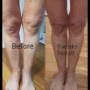 Plasma skin tightening (Knees) 
takes 12 weeks for full results.
amazing results Happy client.
Beyond Skin Face And Body.
