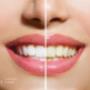 Teeth Whitening