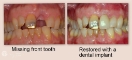 Dental Implants