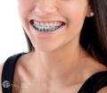 Best Dental Braces Treatment