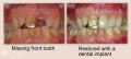 Best Dental Implants