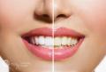 Best Teeth Whitening