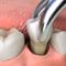 Dental-Extraction