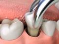 Dental-Extraction