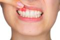 Gum-Disease