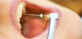 Root-Canal-Treatment