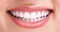 Teeth-Whitening
