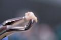 Wisdom-Tooth-Extraction