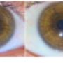 Iridology