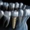 Dental-Implants