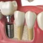 Tooth Implants