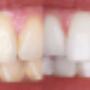 Teeth Whitening