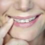 Orthodontics – braces & teeth straighteners