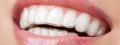 Best Teeth Whitening Treatment