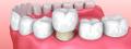 Best Crowns, Bridges and Veneers Treatment