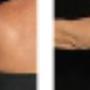 Arm Fat Freezing