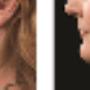 Double Chin Removal