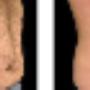 Stomach Fat Freezing