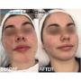 Acne Laser Treatments