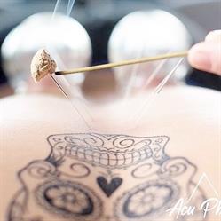 Bribie Island Acupuncture