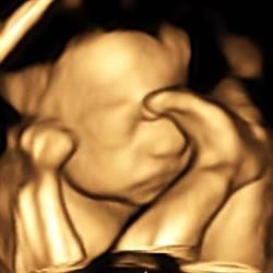 Bub-Scan 3D/4D Ultrasound