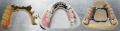 Partial Dentures