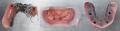 Implant-Retained-Dentures