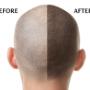 Scalp Micropigmentation Before and After