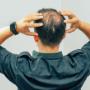 Scalp Micropigmentation for Bald Patches