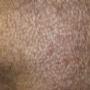 Scalp Micropigmentation for Scars