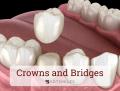 Crowns and Bridges