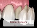 Dental Veneers