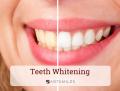 Teeth Whitening