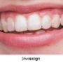 Invisalign1