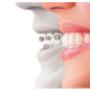 Invisalign