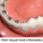 Lingual Braces